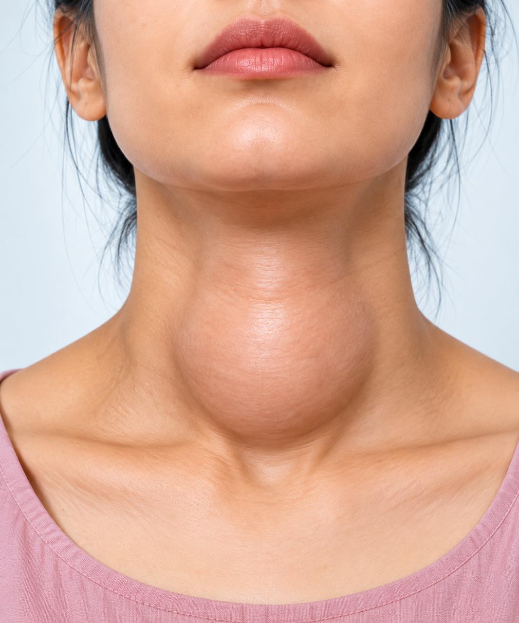 Thyroid Disorders & Surgical Management - Velura Clinic